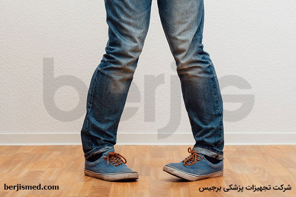 زانو ضربدری (پای ضربدری) چیست؟