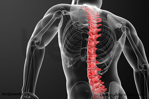 درباره اسکولیوز (انحراف یا کجی ستون فقرات) بیشتر بدانید