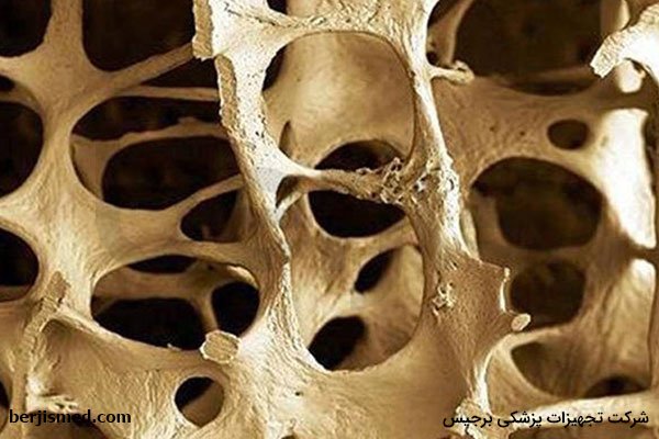 روش‌های درمان پوکی استخوان ناشی از گلوکوکورتیکوئید کدامند؟