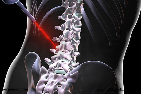 هر آنچه که باید درباره عمل جراحی دیسک کمر با لیزر بدانید