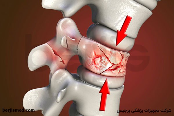 با انواع شکستگی مهره های کمر آشنا شوید