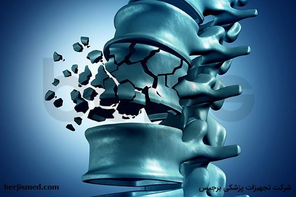 پوکی استخوان چیست و چگونه باید از دچار شدن به آن جلوگیری کرد؟