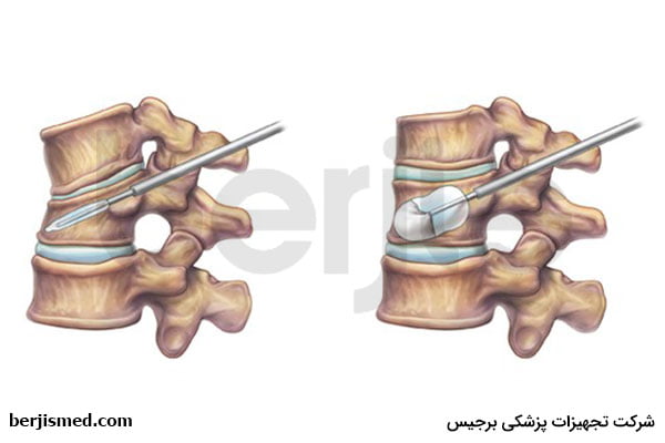 معایب انجام ورتبروپلاستی و کایفوپلاستی چیست؟