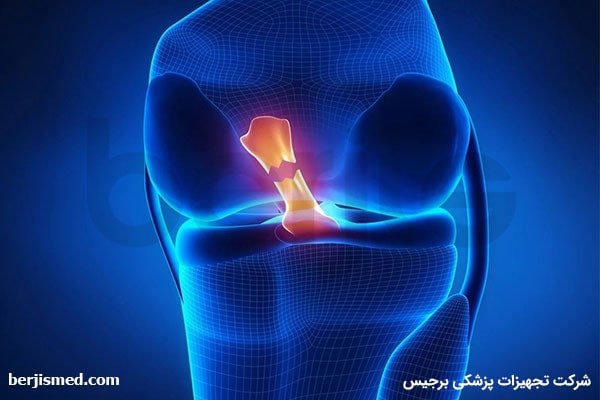 درمان پارگی رباط صلیبی زانو