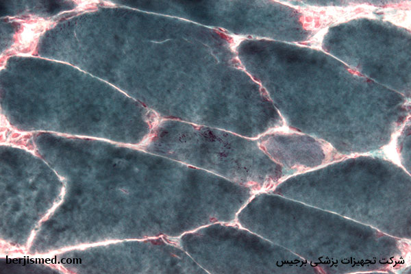 علائم بیماری میوپاتی چیست؟