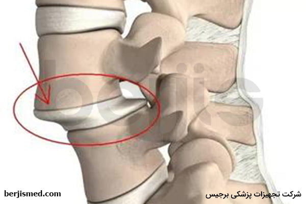 لیز خوردگی مهره (اسپوندیلولیستزیس)