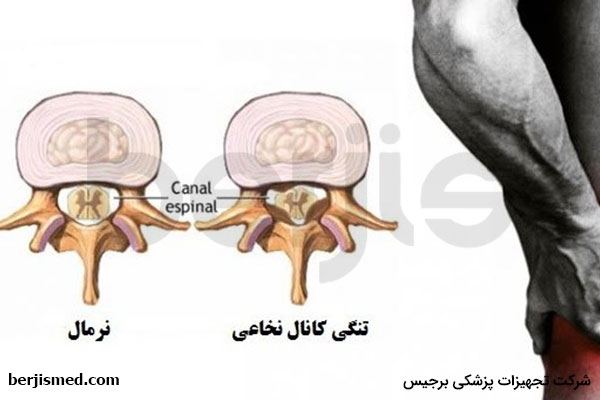 علت و درمان تنگی کانال نخاعی و علائم آن
