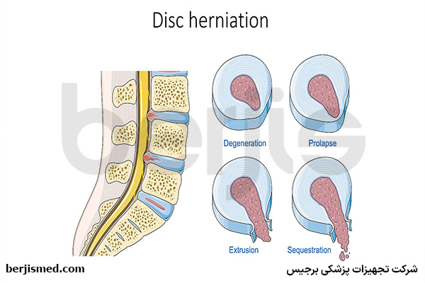 انواع فتق دیسک