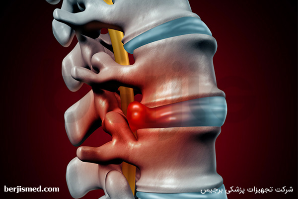 دلایل بروز فتق دیسک و روش های درمان فتق دیسک