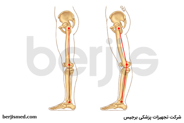 عقب زدگی زانو یا ژنورکورواتوم چیست؟