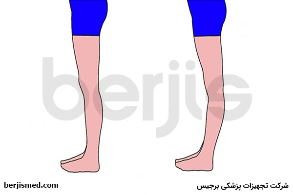 علت های عقب زدگی زانو