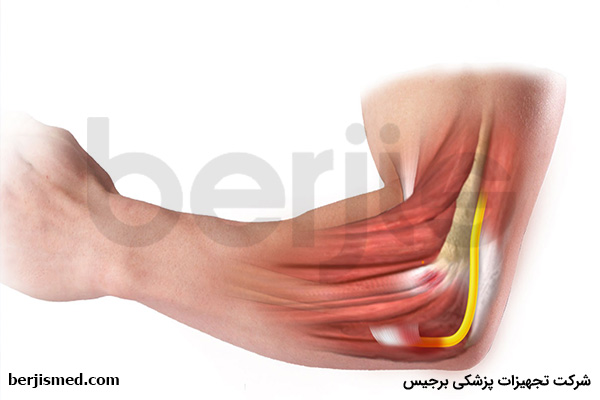 علائم سندرم گیر افتادگی عصب