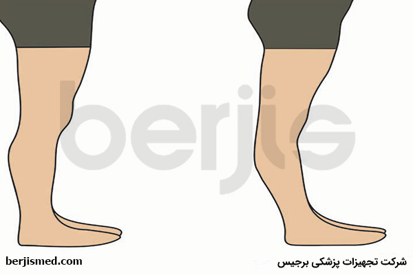 علائم بروز عقب زدگی زانو یا ژنورکورواتوم