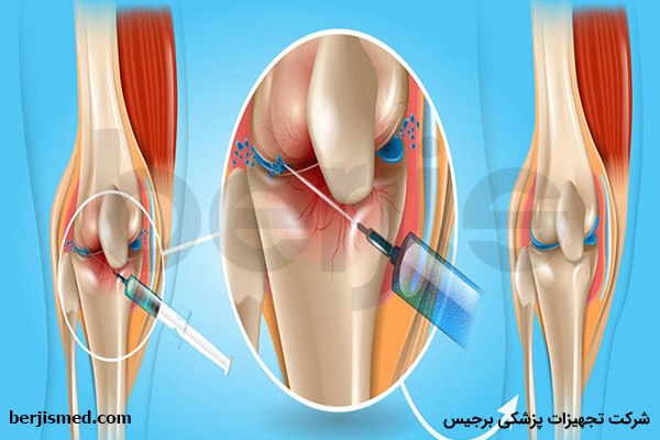تخلیه آب زانو یکی از راه های درمان قطعی آب آوردن زانو