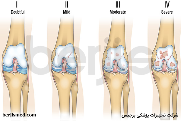 آرتروز زانو و علائم و دلایل بروز آن چیست؟