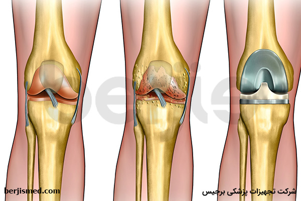 روش های درمان آرتروز زانو