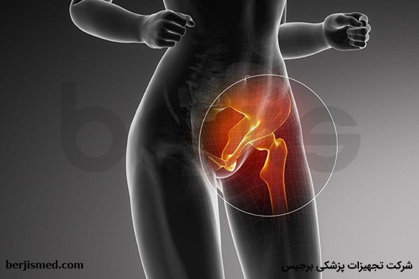 سندرم گیر افتادگی مفصل ران چیست؟