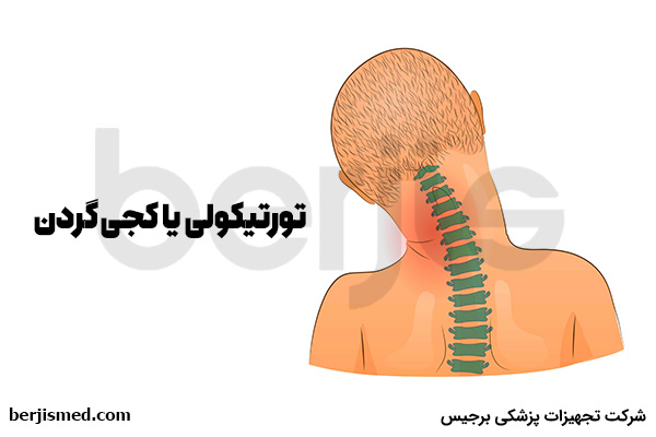 تورتیکولی یا کجی گردن و درمان آن با فیزیوتراپی