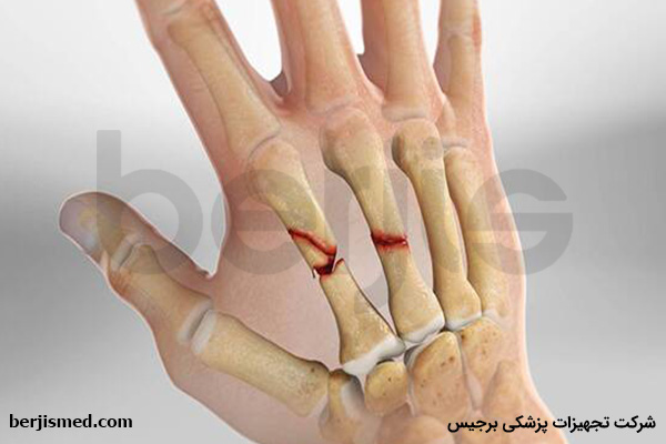 شکستگی استخوان های متاکارپ چیست؟