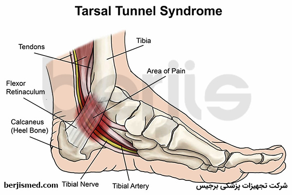علائم سندرم تونل تارسال
