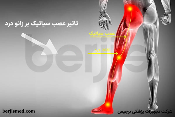تاثیر عصب سیاتیک بر زانو درد