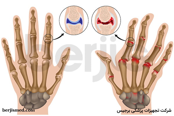 روش درمان بیماری استئوآرتریت