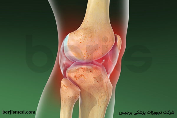 استئوآرتریت زانو و راه های تشخیص و درمان آن چیست؟