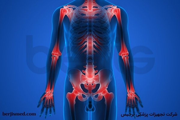 بیماری استئوآرتریت چیست؟