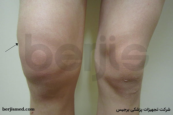 علت آب آوردن زانو چیست؟