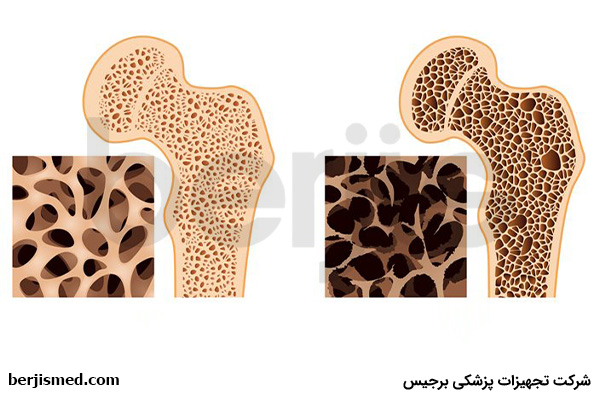 درمان پوکی استخوان در زنان باردار