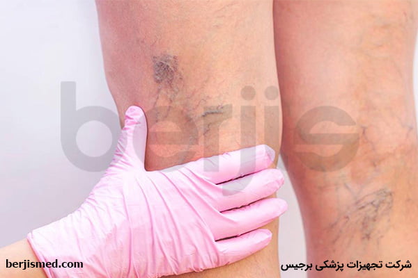 برای درمان واریس پا به طور منظم ورزش کنید