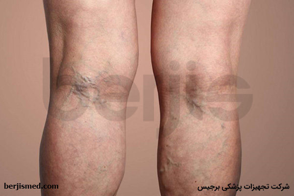 مزایای درمان خانگی واریس پا چیست؟