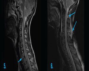 ضایعه نخاعی