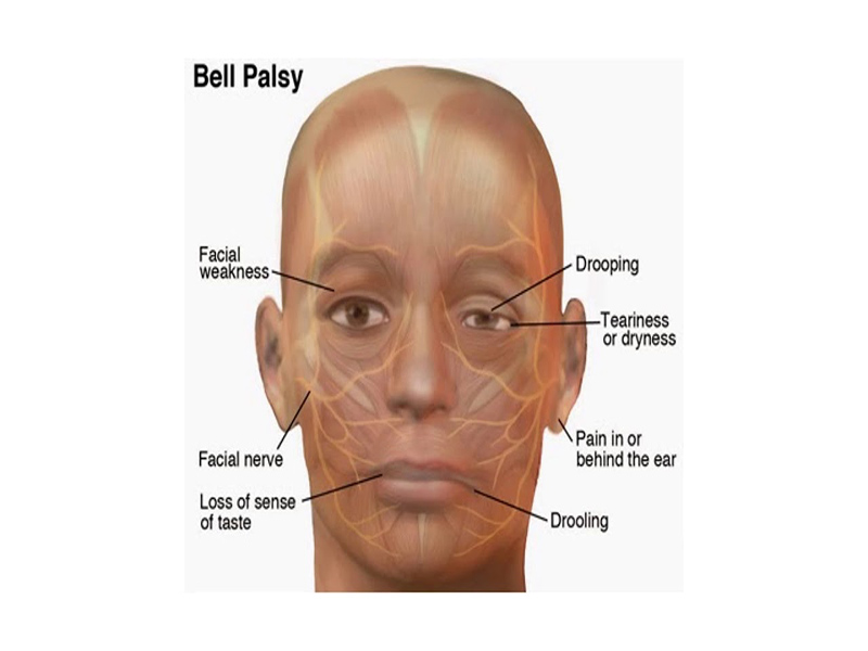 دلایل فلج بلز