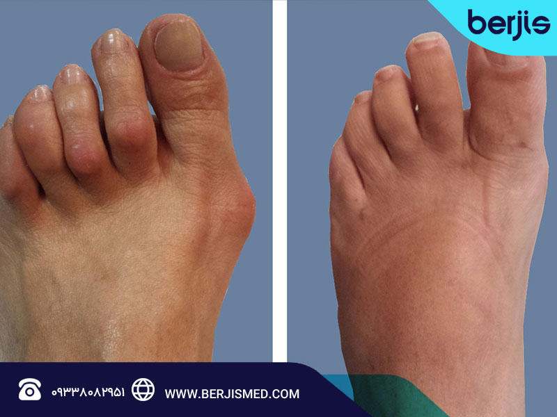 انگشت چکشی: علل، تشخیص و روش‌های درمان