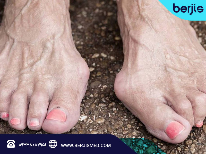 اصلی ترین دلایل انگشت چکشی را بشناسید