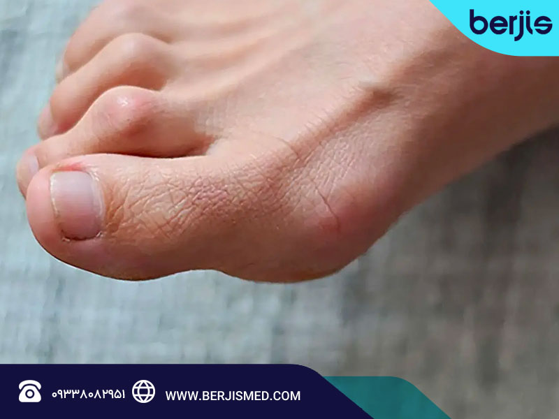 درمان انگشت چکشی با فیزیوتراپی