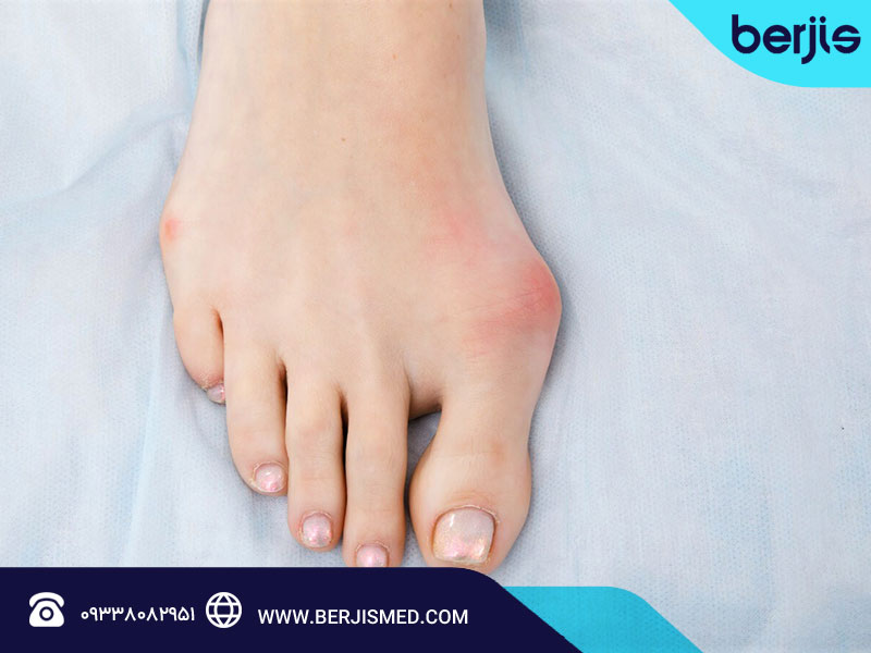 روش های جراحی برای درمان انگشت چکشی