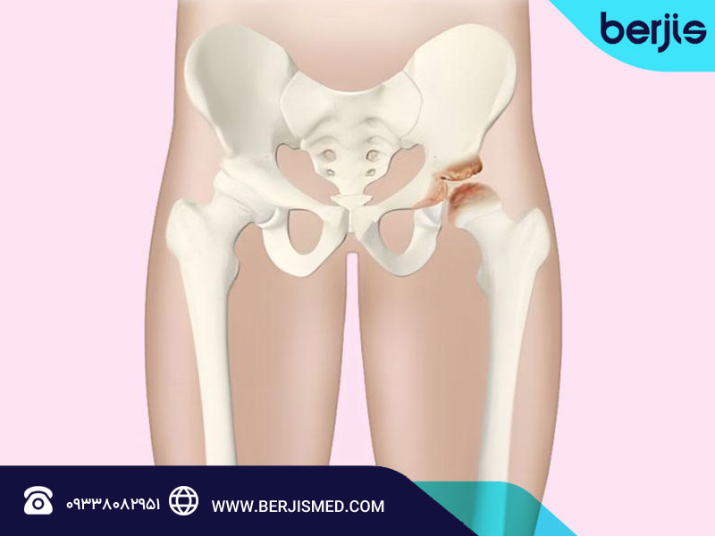 بیماری پرتس و روش های درمان آن