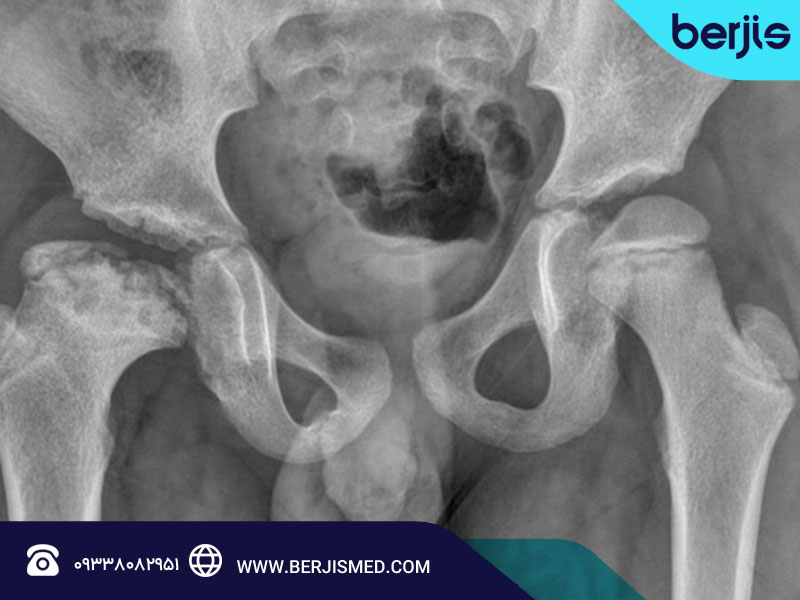 بیماری پرتس چگونه تشخیص داده میشود؟